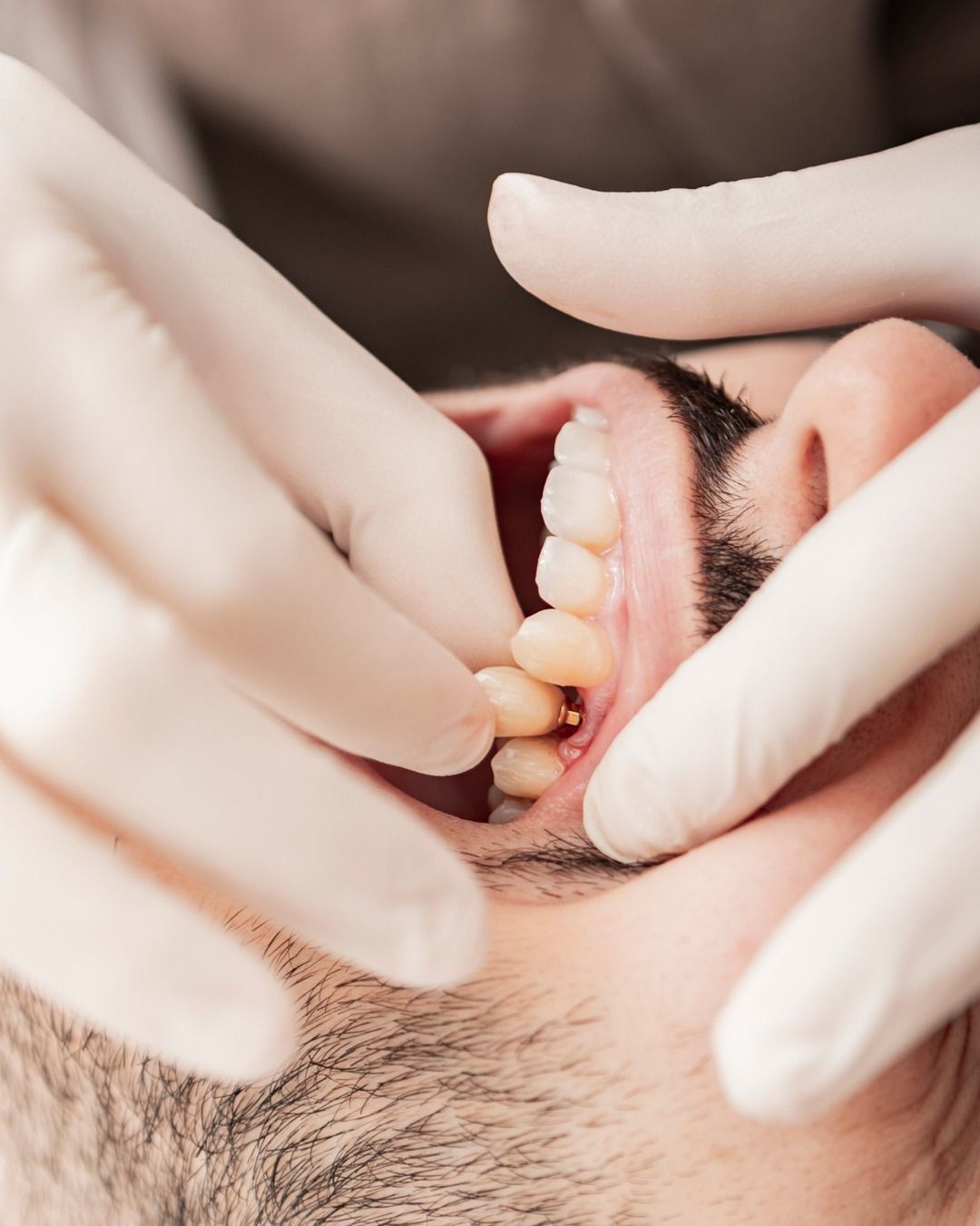 Implantes Dentários: mitos e verdades